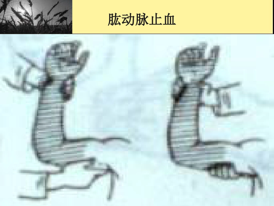 创伤现场急救_第15页