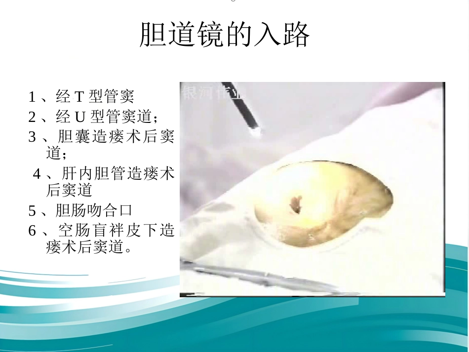 胆道镜的使用_第11页