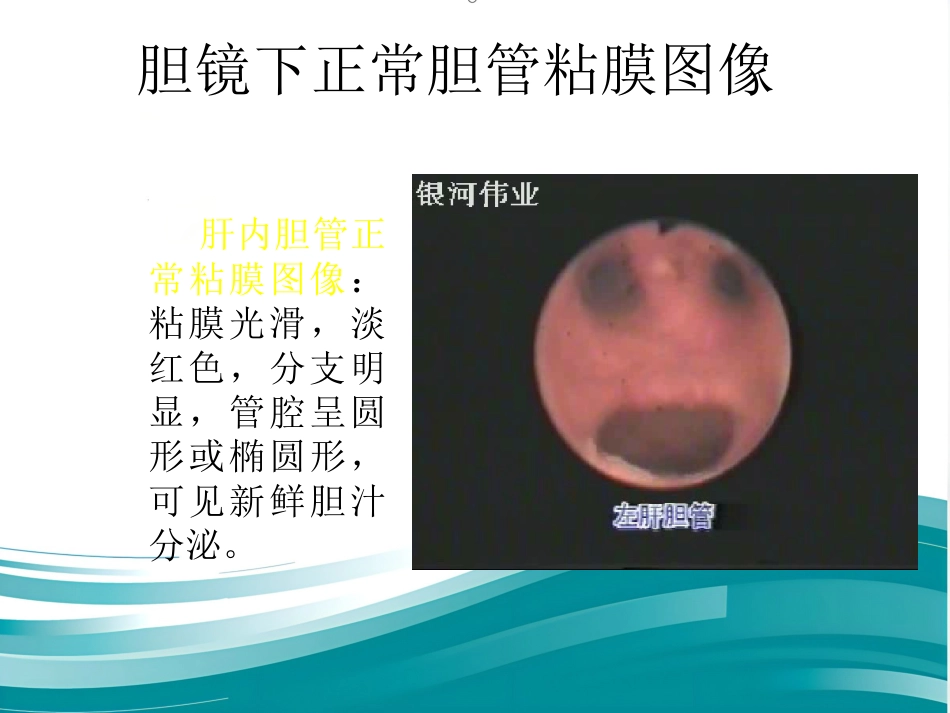 胆道镜的使用_第14页