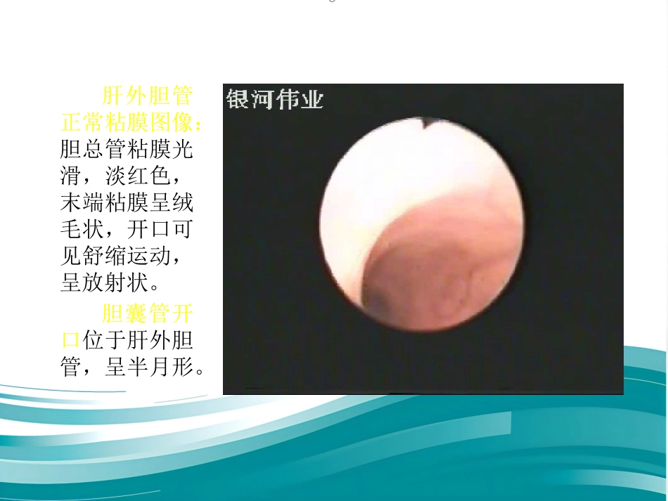 胆道镜的使用_第15页