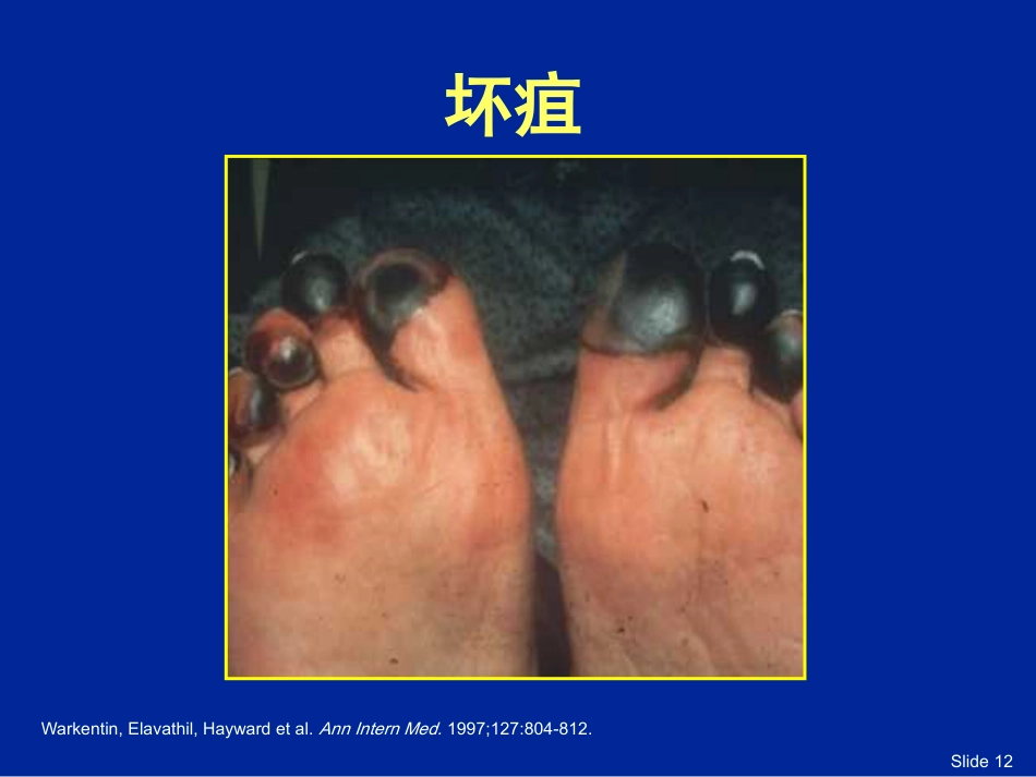 HIT肝素诱导的血小板减少症_第12页