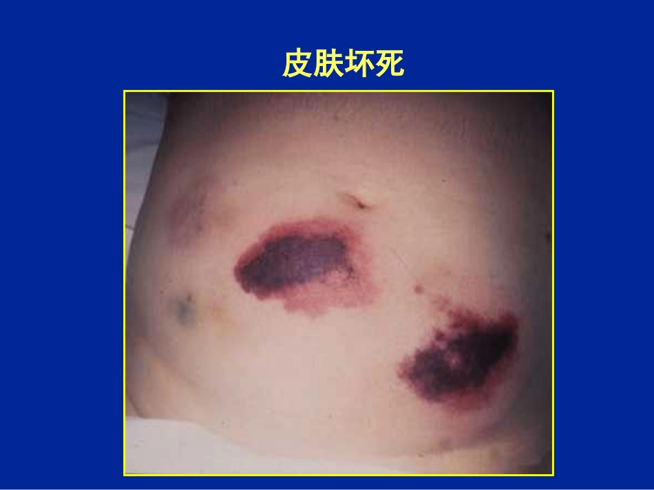 HIT肝素诱导的血小板减少症_第14页