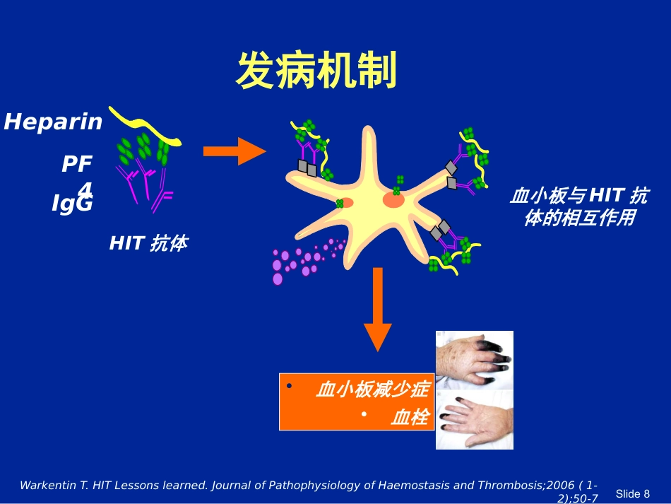 HIT肝素诱导的血小板减少症_第8页