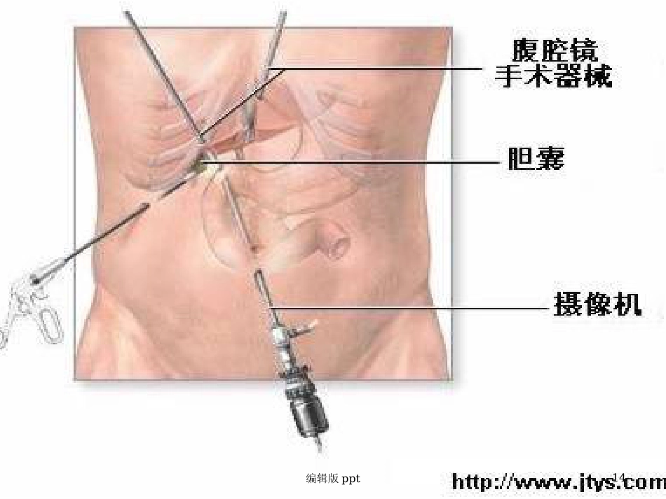 胆囊相关知识 ppt课件_第14页