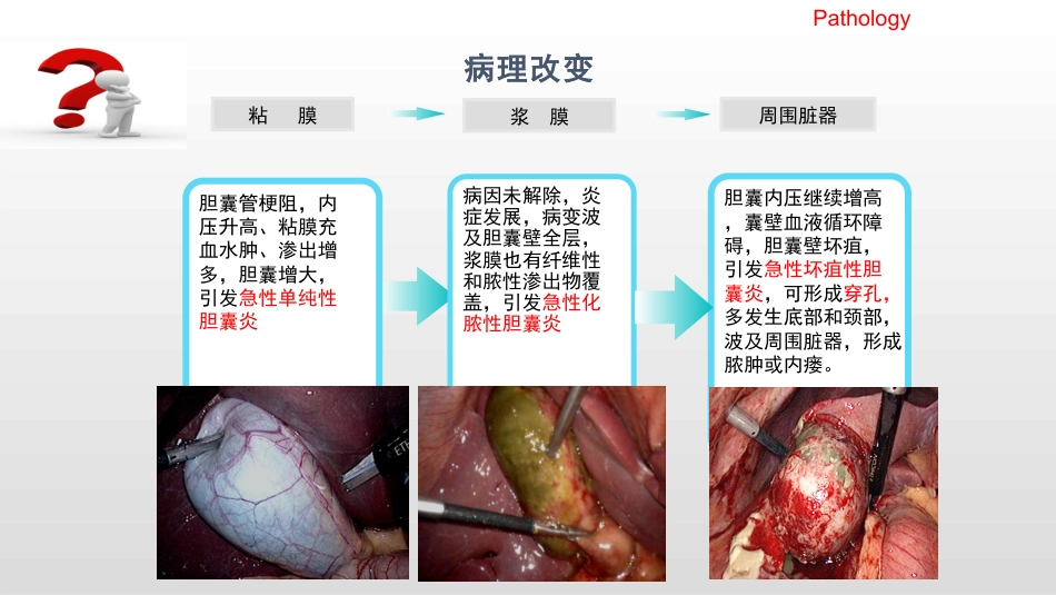 胆囊炎 规培讲课_第6页