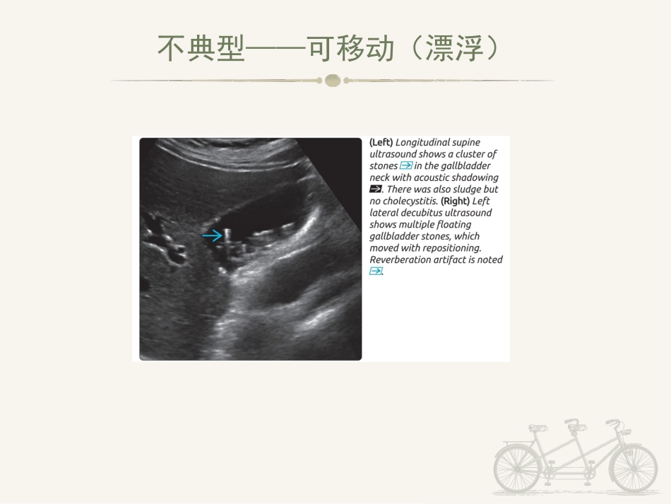胆囊炎ppt_第12页