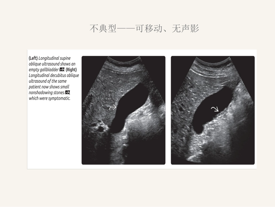 胆囊炎ppt_第13页