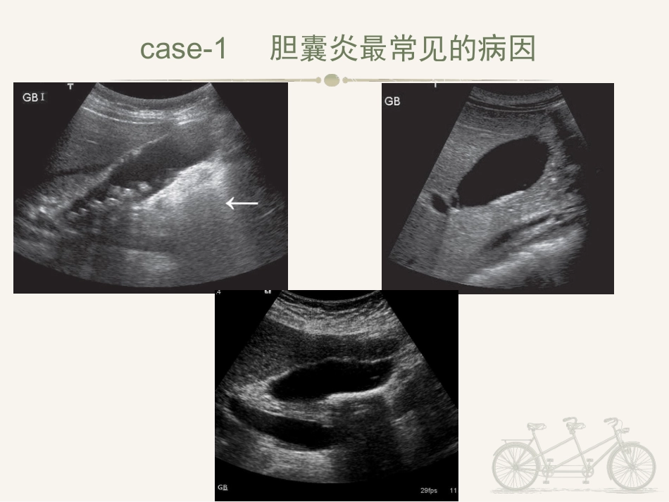 胆囊炎ppt_第2页