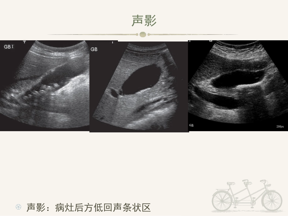 胆囊炎ppt_第7页