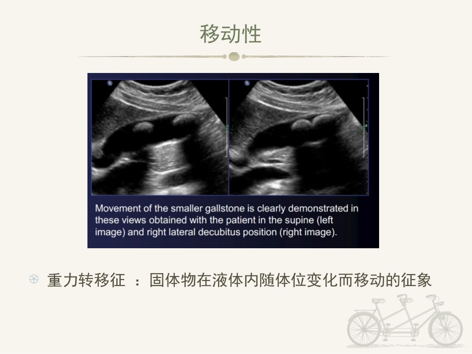 胆囊炎ppt_第8页