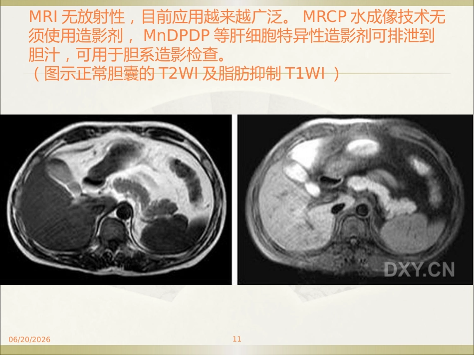 胆系疾病ppt课件_第11页