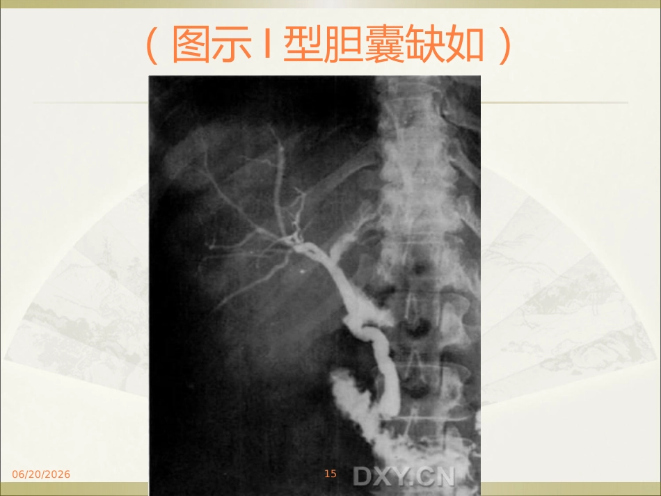 胆系疾病ppt课件_第15页