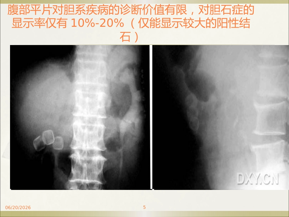 胆系疾病ppt课件_第5页