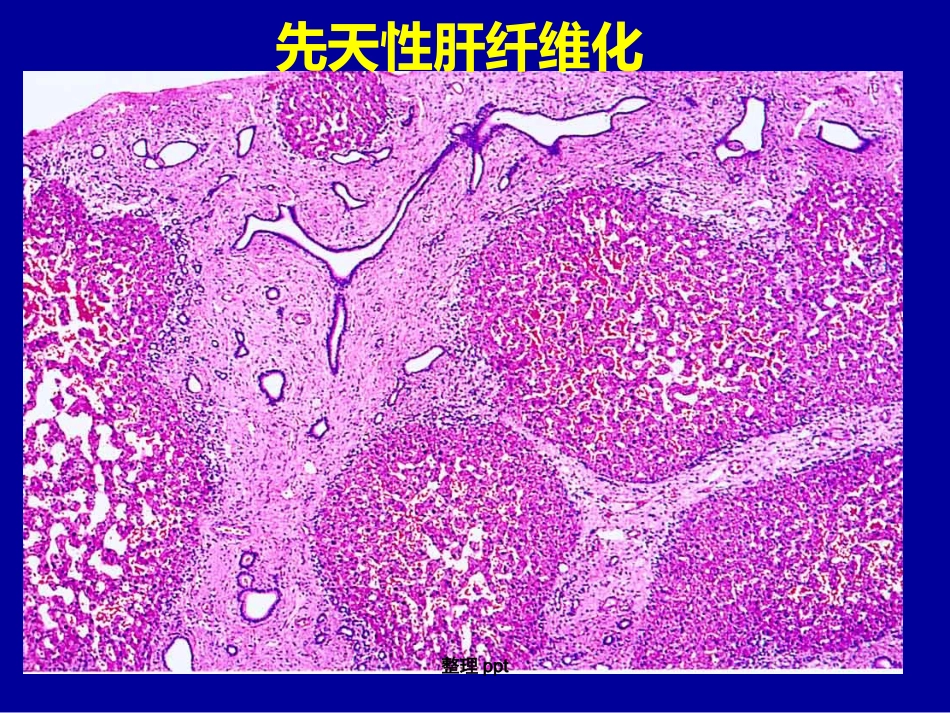 非肝硬化性门脉高压的诊断要点_第10页