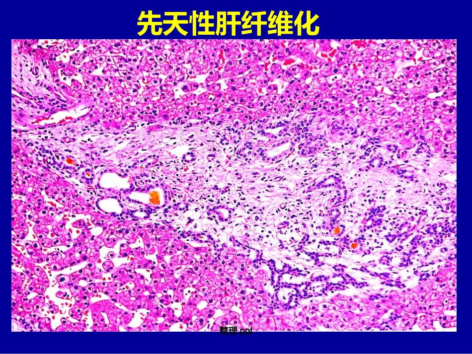 非肝硬化性门脉高压的诊断要点_第11页
