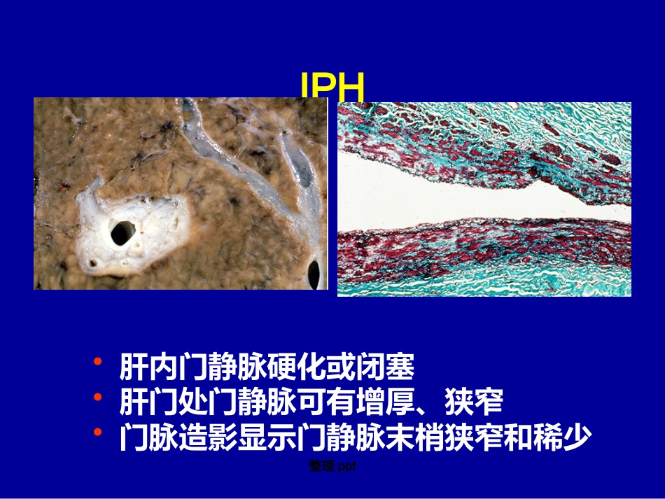 非肝硬化性门脉高压的诊断要点_第15页