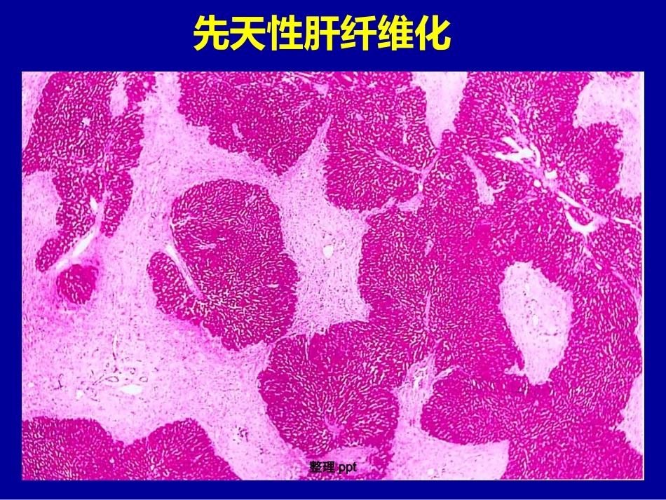 非肝硬化性门脉高压的诊断要点_第9页