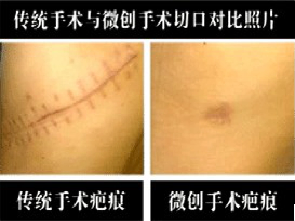 腹腔镜下胆囊切除ppt课件_第3页