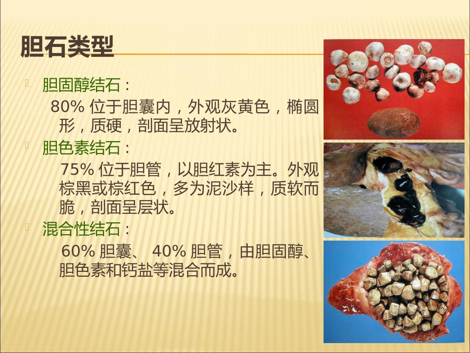 胆囊结石合并胆囊炎教学查房_第13页