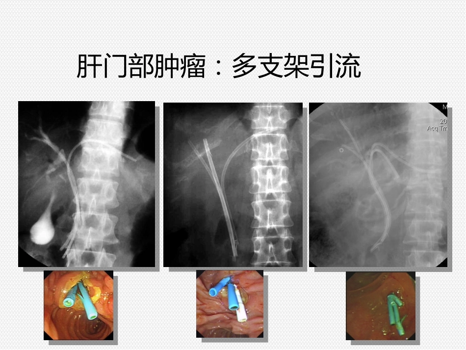 ERCP治疗胆胰疾病_第10页