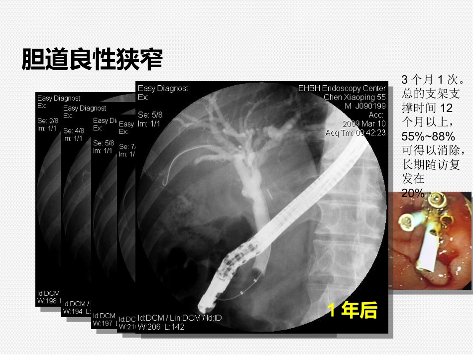 ERCP治疗胆胰疾病_第13页