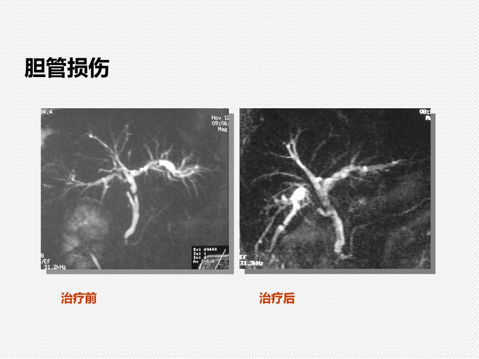 ERCP治疗胆胰疾病_第14页