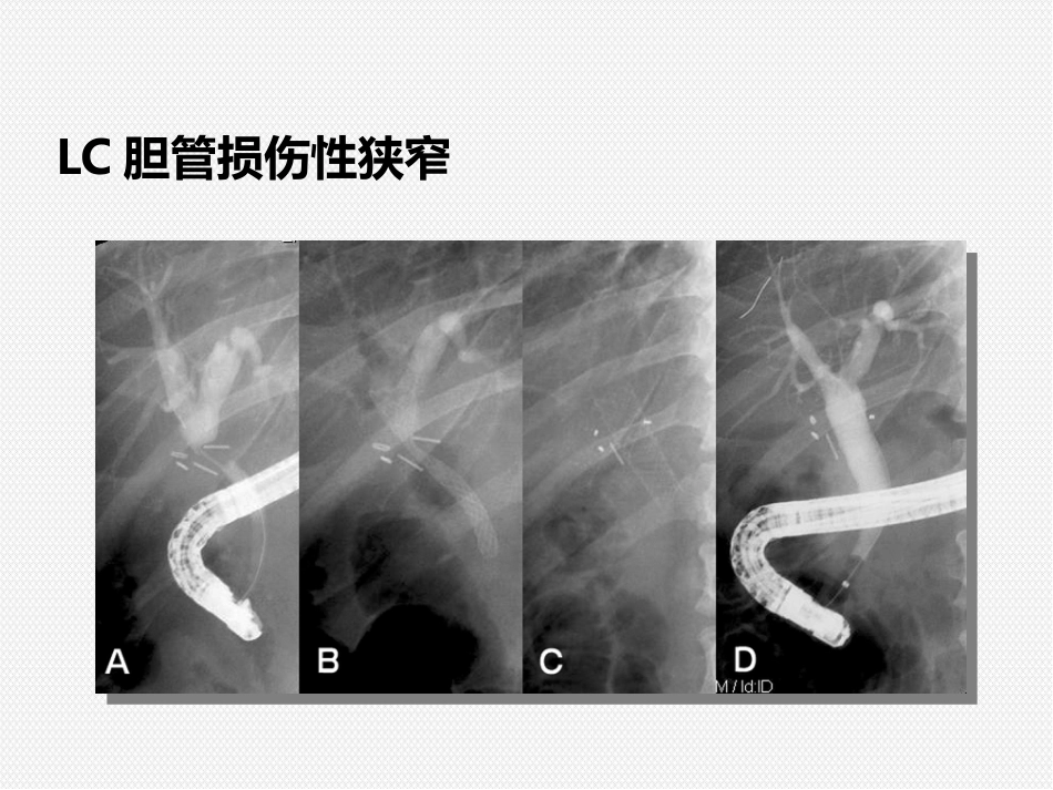 ERCP治疗胆胰疾病_第15页