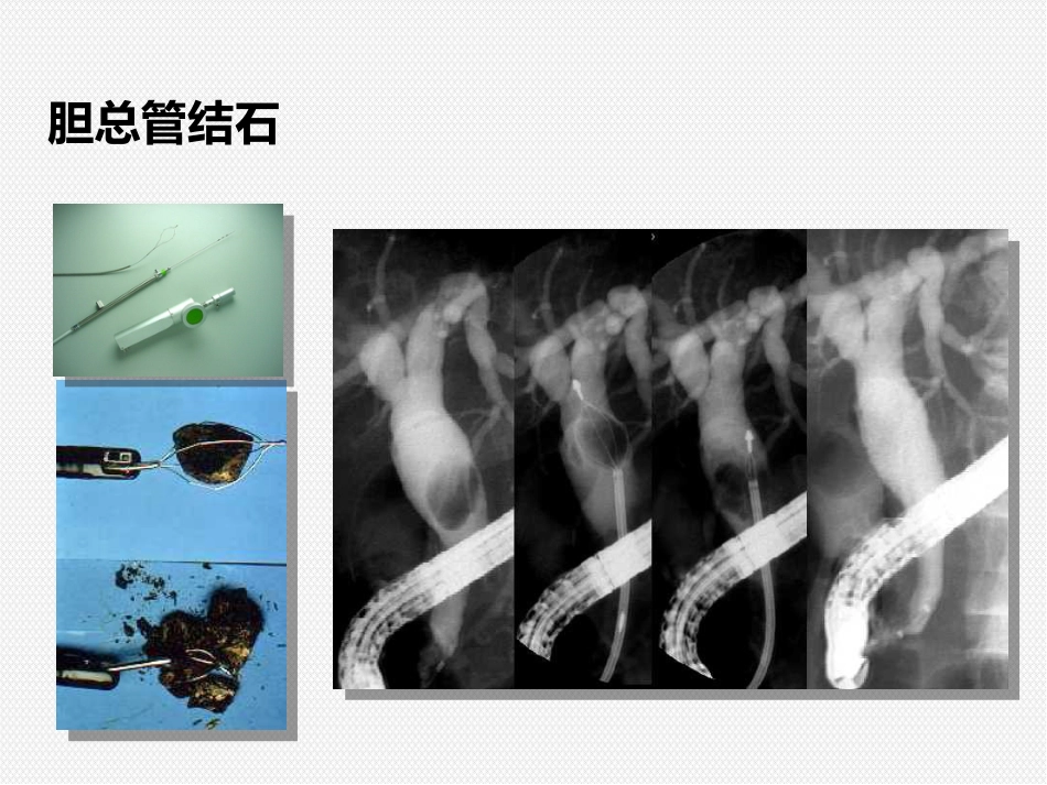 ERCP治疗胆胰疾病_第6页