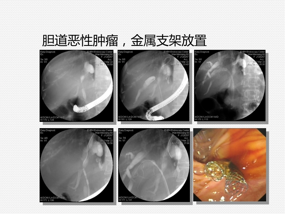 ERCP治疗胆胰疾病_第9页