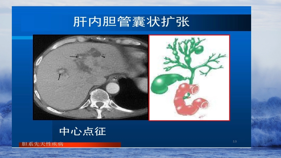胆系先天性疾病_第12页