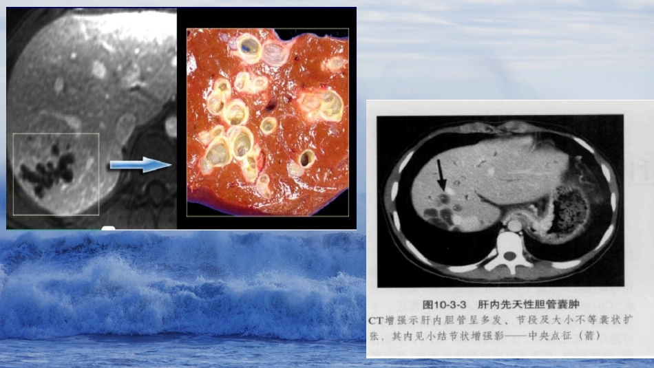 胆系先天性疾病_第13页