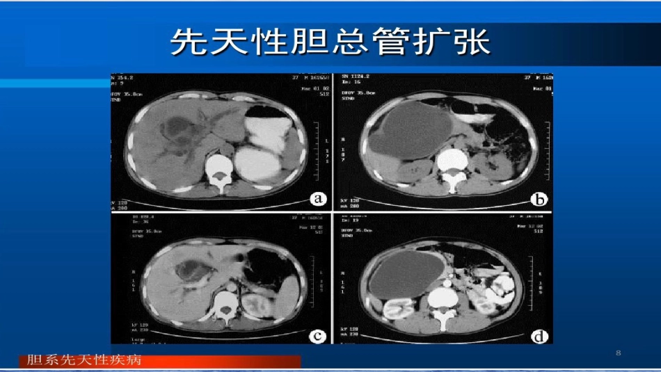 胆系先天性疾病_第7页