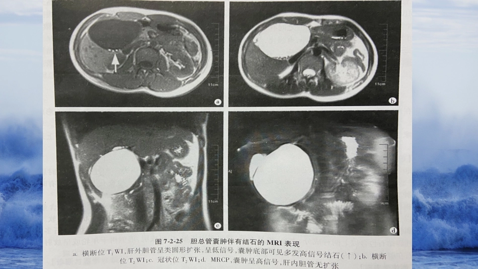 胆系先天性疾病_第8页