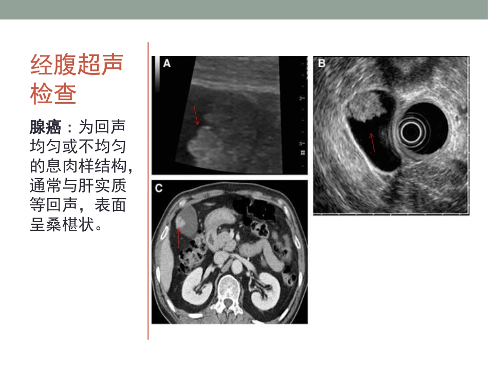 胆囊息肉的随访_第10页