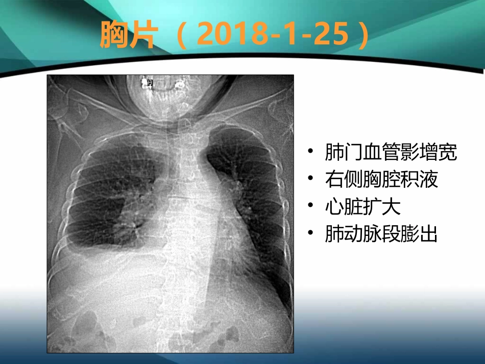 肺高压的利尿策略-ASD+PS+乙肝肝硬化_第10页