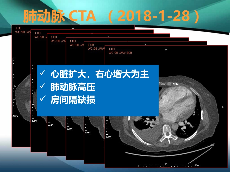 肺高压的利尿策略-ASD+PS+乙肝肝硬化_第15页