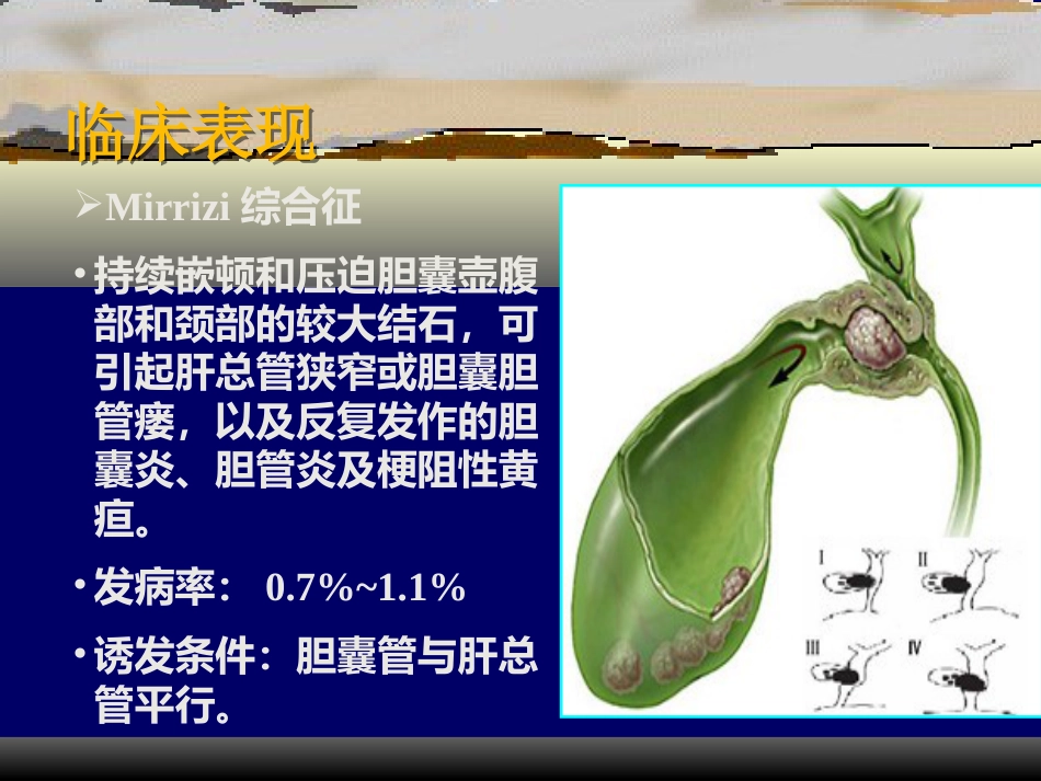 胆囊疾病PPT_第13页