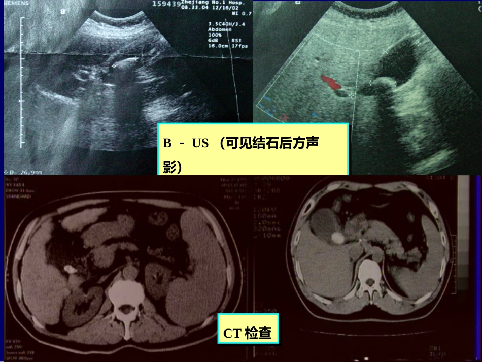 胆囊疾病PPT_第14页