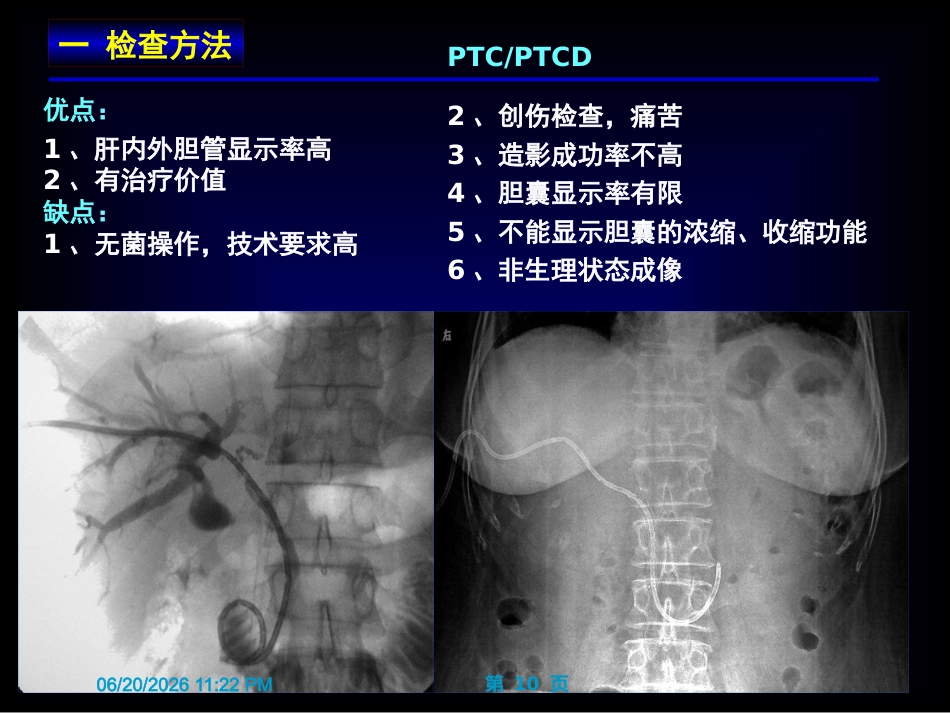胆囊炎影像诊断PPT_第10页