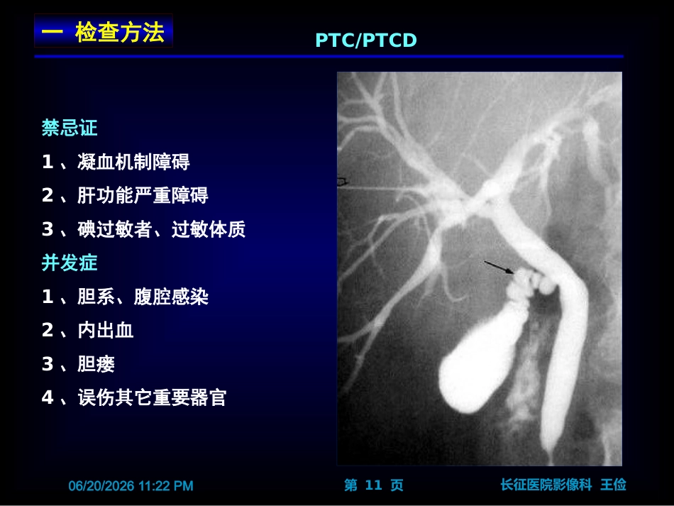 胆囊炎影像诊断PPT_第11页