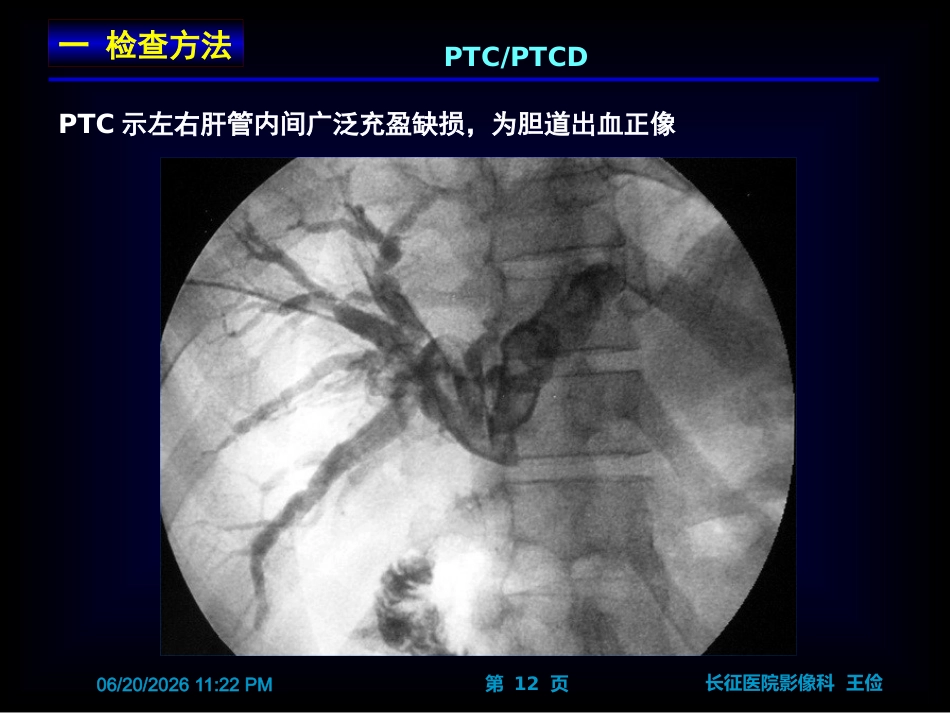 胆囊炎影像诊断PPT_第12页