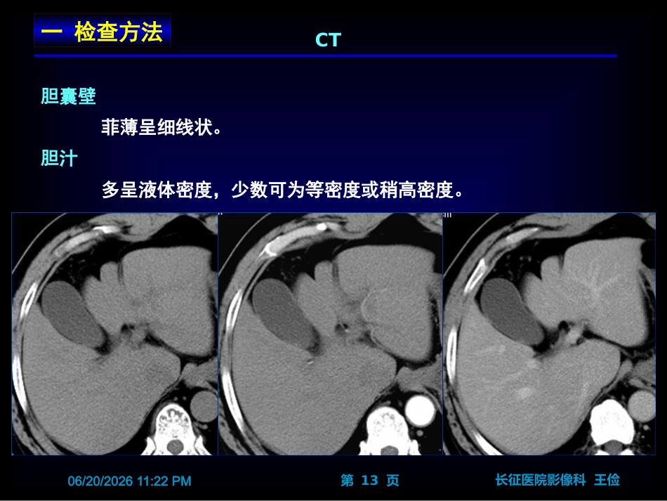 胆囊炎影像诊断PPT_第13页