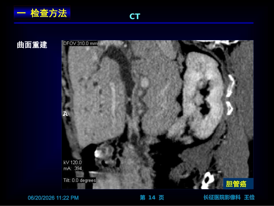 胆囊炎影像诊断PPT_第14页