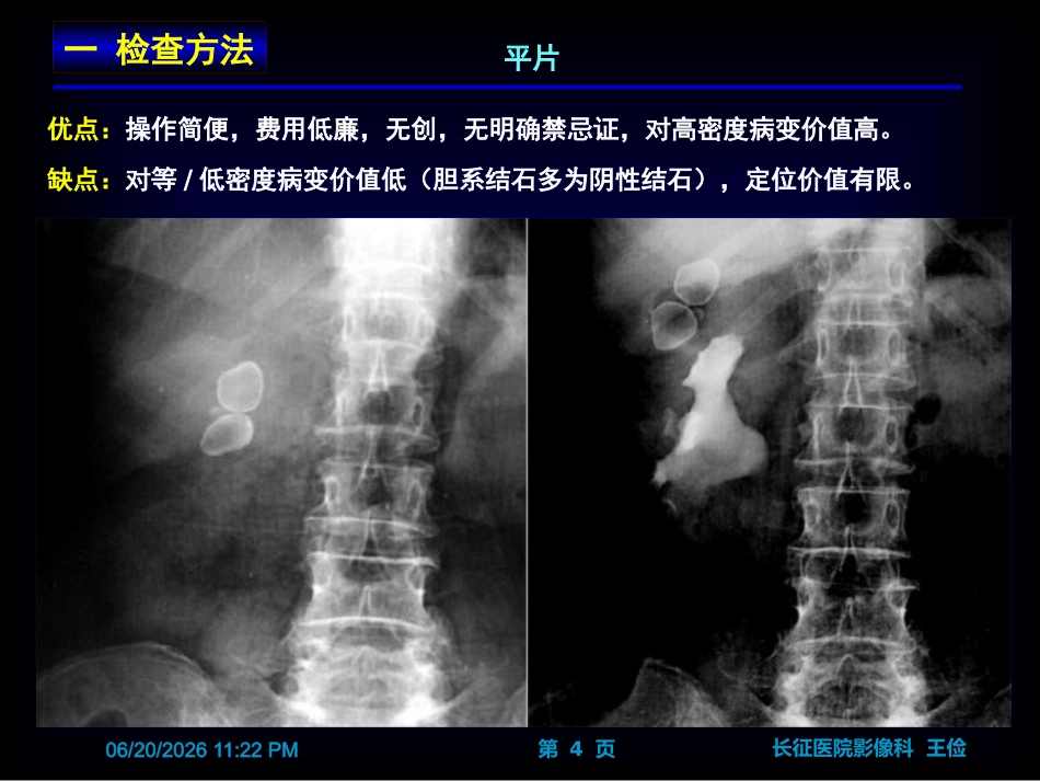 胆囊炎影像诊断PPT_第4页