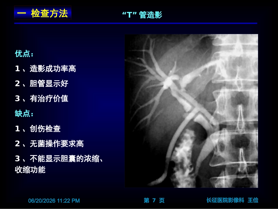 胆囊炎影像诊断PPT_第7页