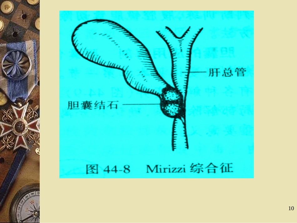 胆石病PPT课件_第10页