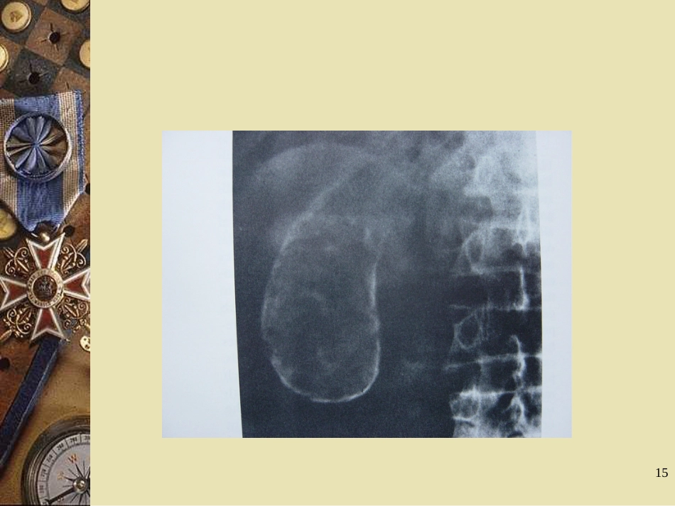 胆石病PPT课件_第15页