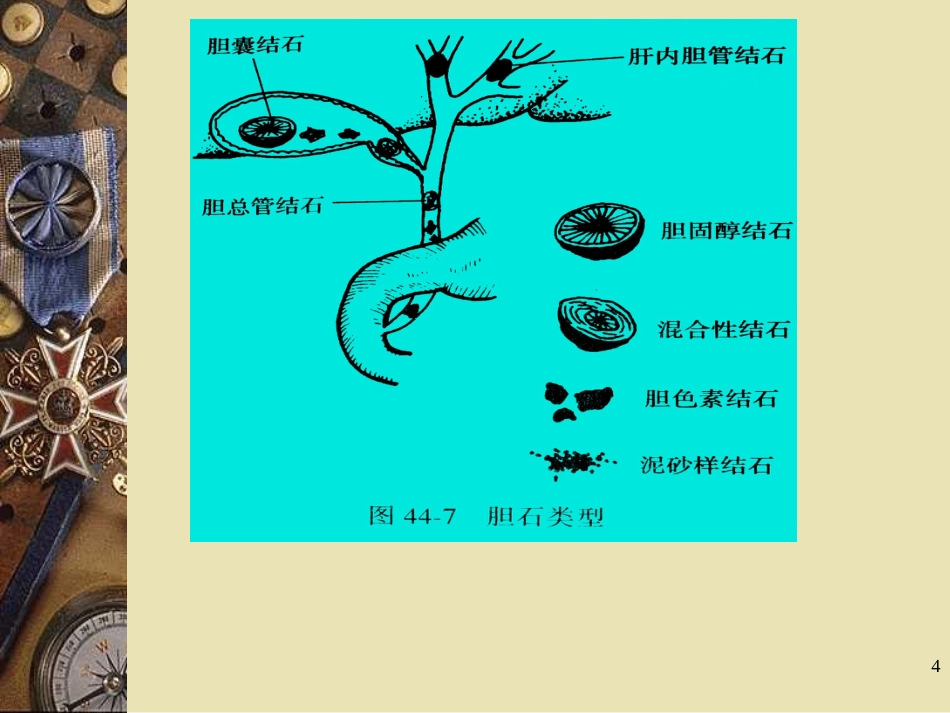 胆石病PPT课件_第4页