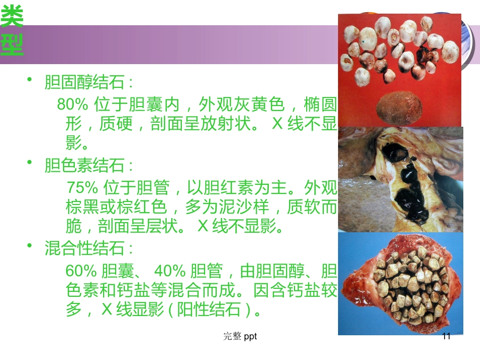 胆囊结石的教学查房_第11页