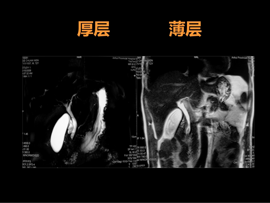 MRCP对胆道疾病的诊断_第4页